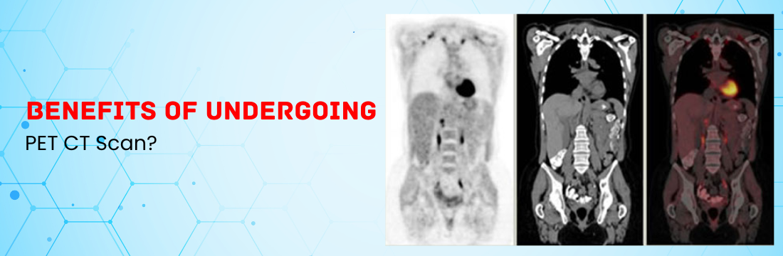 What Are the Benefits of Undergoing a PET CT Scan?